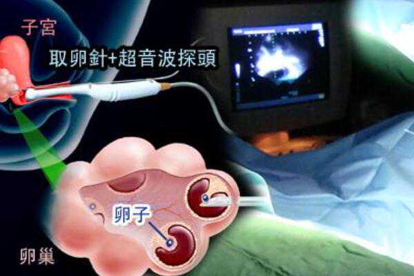 广州金贝供卵医院官网,广州中山六院可以供卵-代孕医院